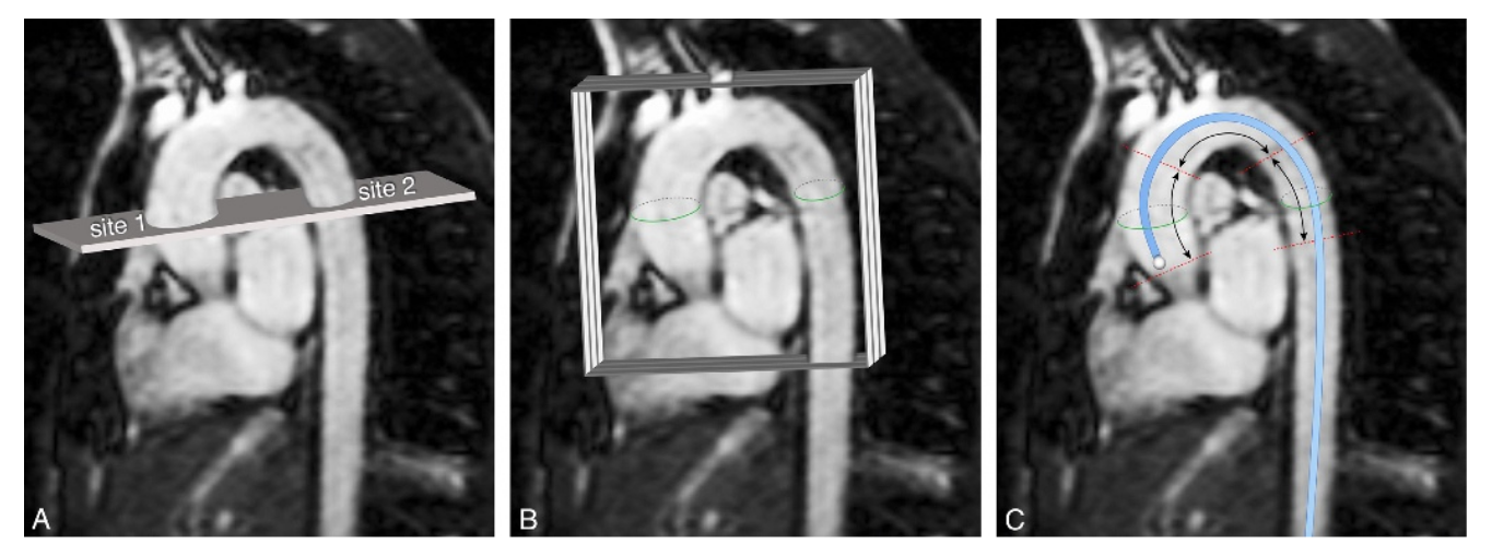 PWV methods schematic used as a stiffness-method boundary for aortic distensibility imaging